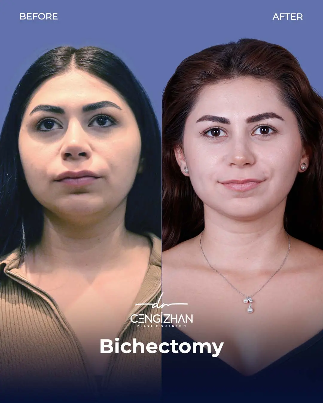 Bichectomy Before and After by Dr. Cengizhan Ekizceli