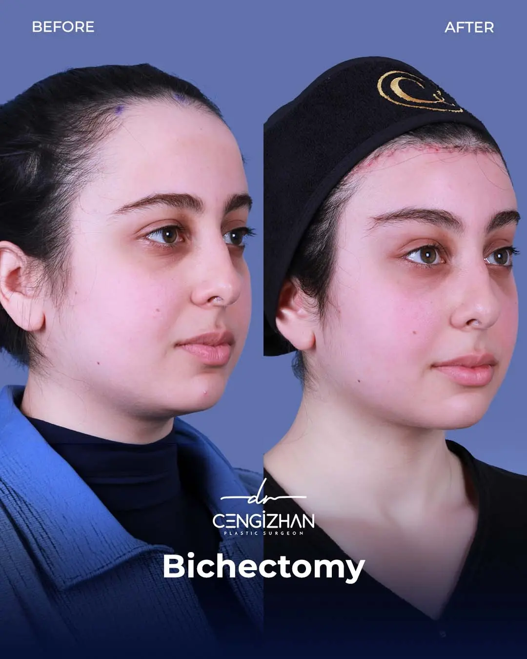 Bichectomy Before and After by Dr. Cengizhan Ekizceli