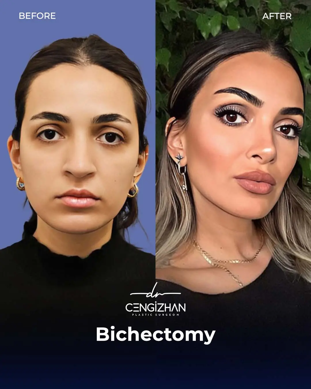 Bichectomy Before and After by Dr. Cengizhan Ekizceli