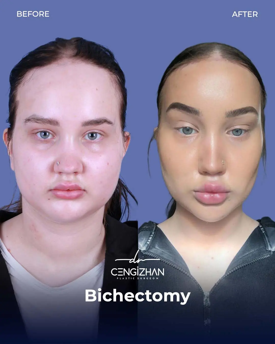 Bichectomy Before and After by Dr. Cengizhan Ekizceli