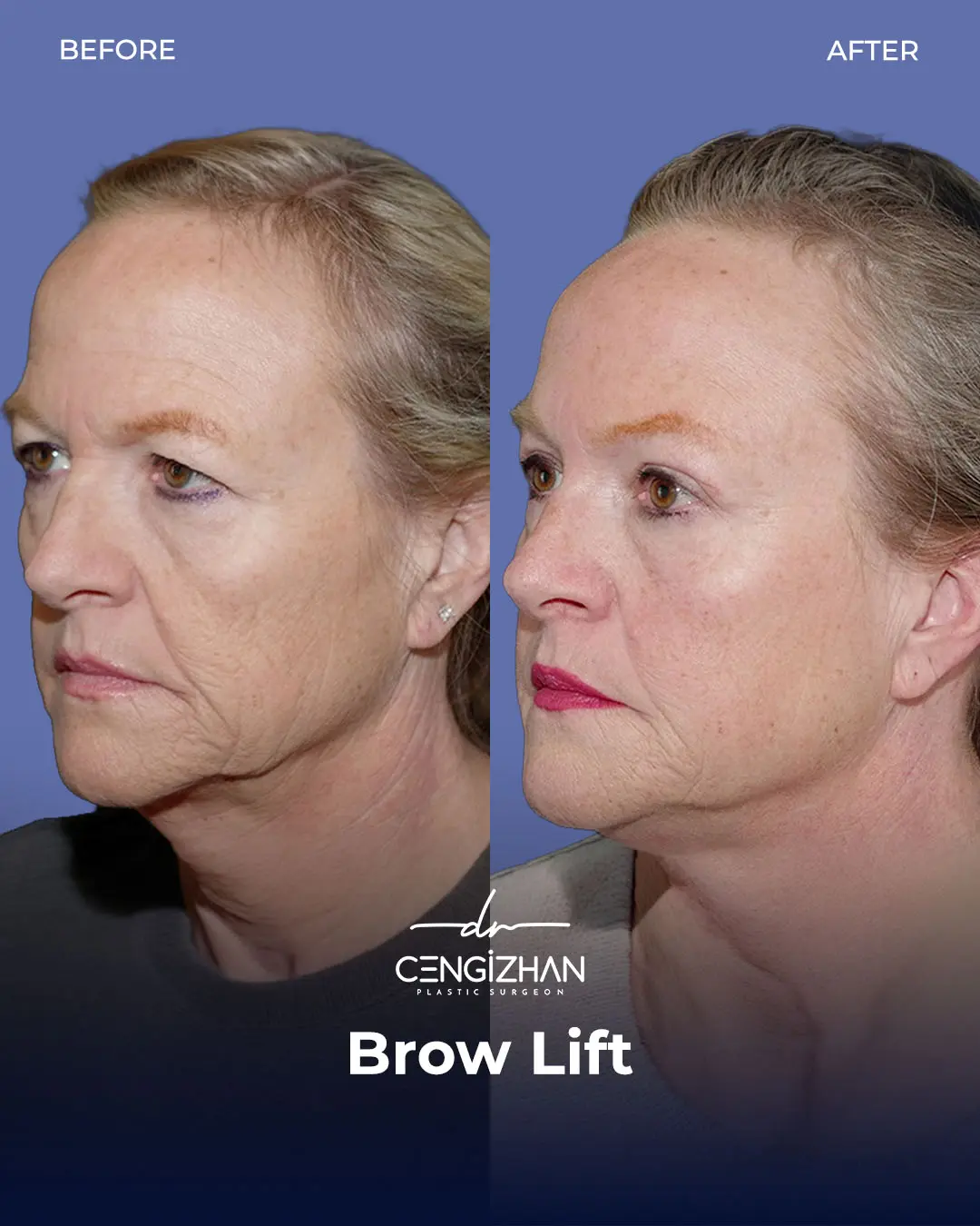 Eyebrow Lift Before and After Transformation by Dr. Cengizhan Ekizceli