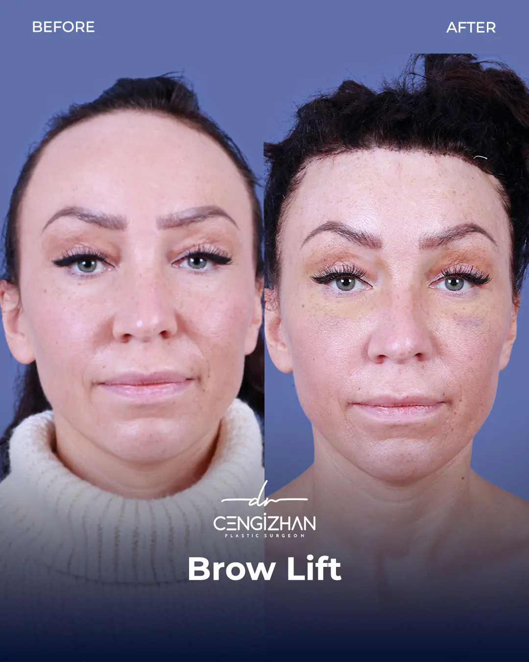 Eyebrow Lift Before and After Transformation by Dr. Cengizhan Ekizceli