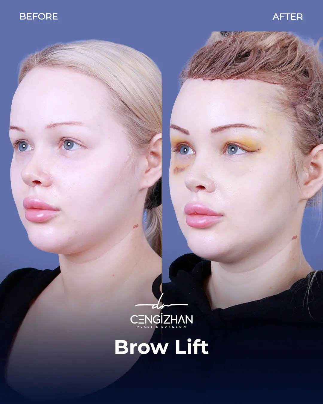 Eyebrow Lift Before and After Transformation by Dr. Cengizhan Ekizceli
