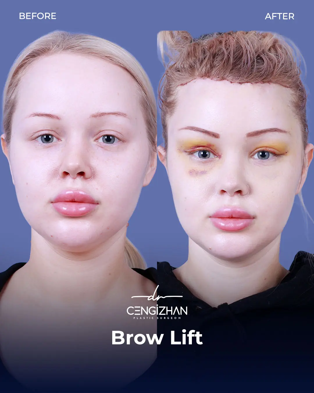 Eyebrow Lift Before and After Transformation by Dr. Cengizhan Ekizceli