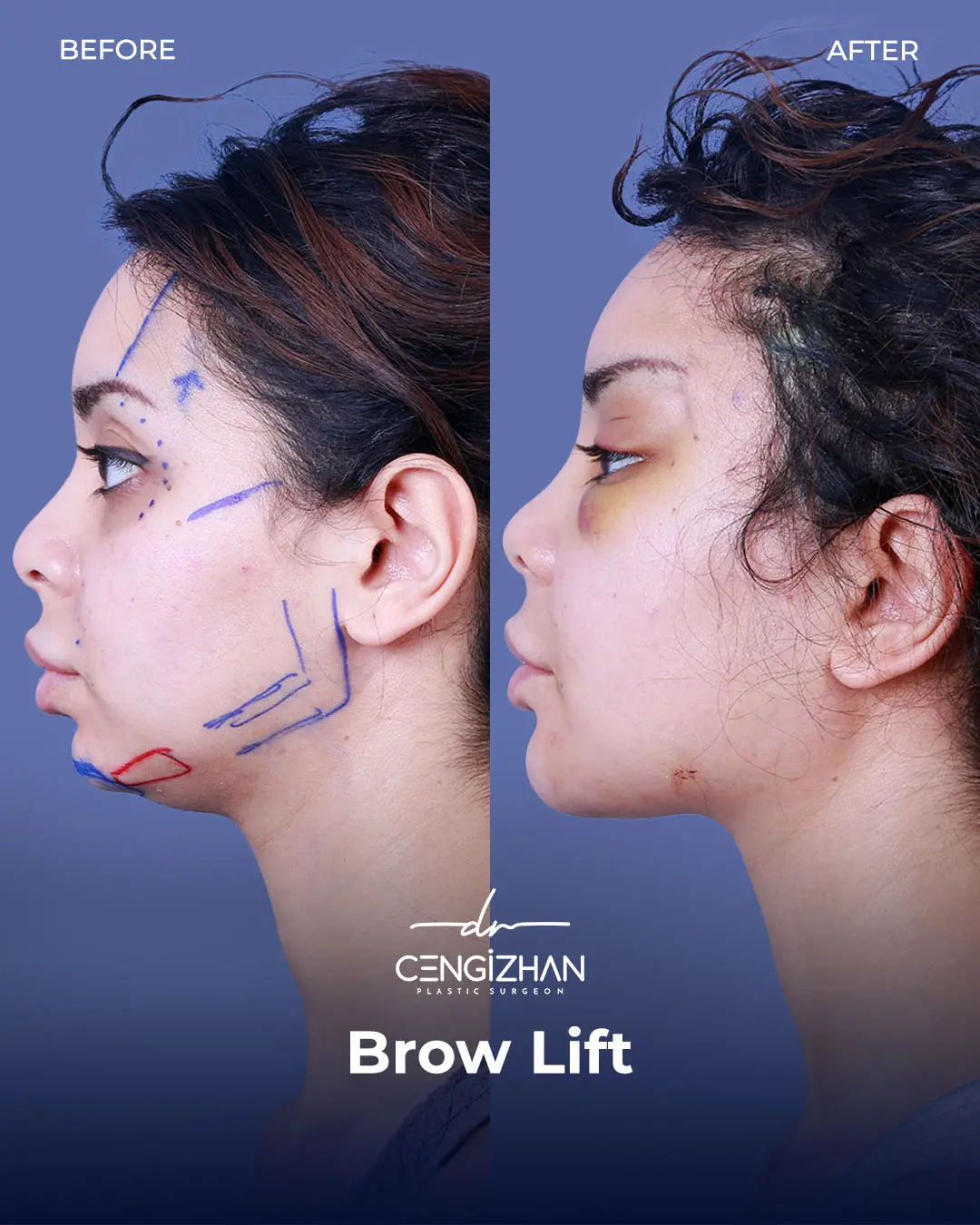 Eyebrow Lift Before and After Transformation by Dr. Cengizhan Ekizceli