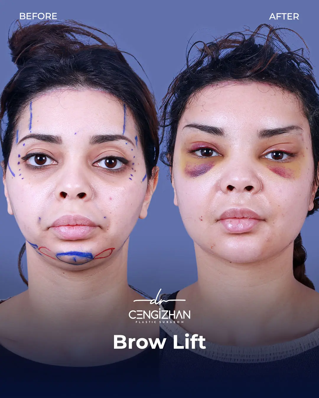 Eyebrow Lift Before and After Transformation by Dr. Cengizhan Ekizceli