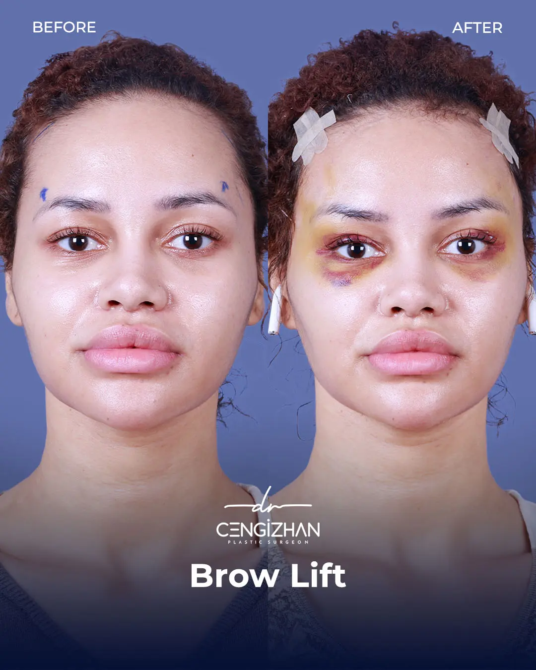 Eyebrow Lift Before and After Transformation by Dr. Cengizhan Ekizceli