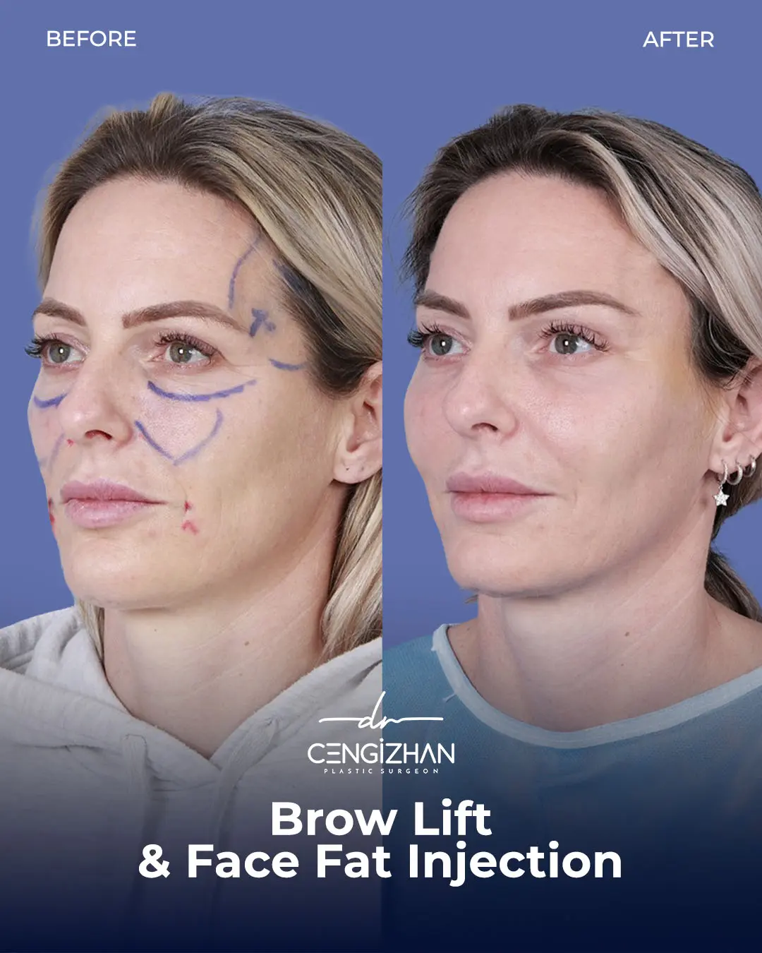 Eyebrow Lift Before and After Transformation by Dr. Cengizhan Ekizceli