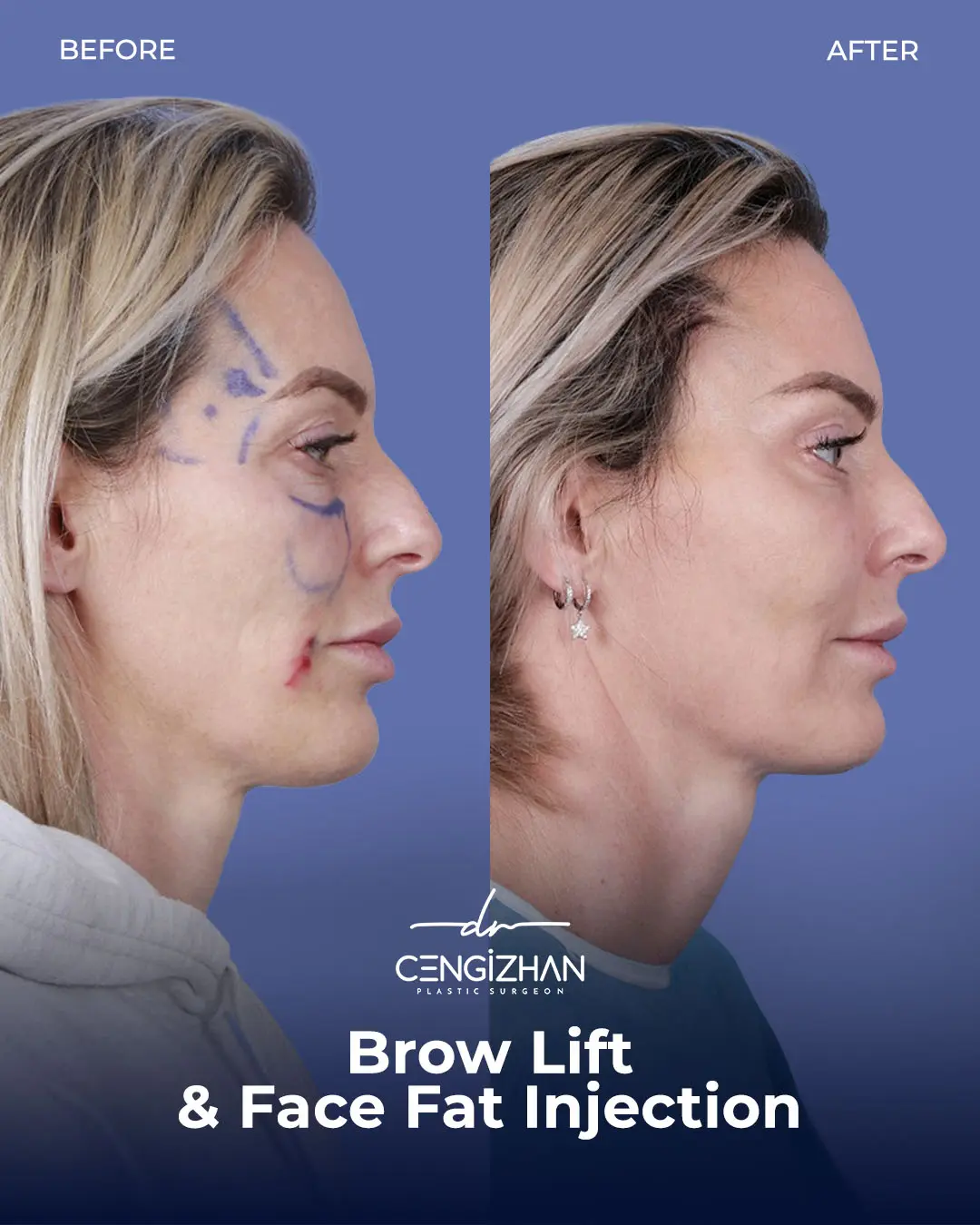 Eyebrow Lift Before and After Transformation by Dr. Cengizhan Ekizceli