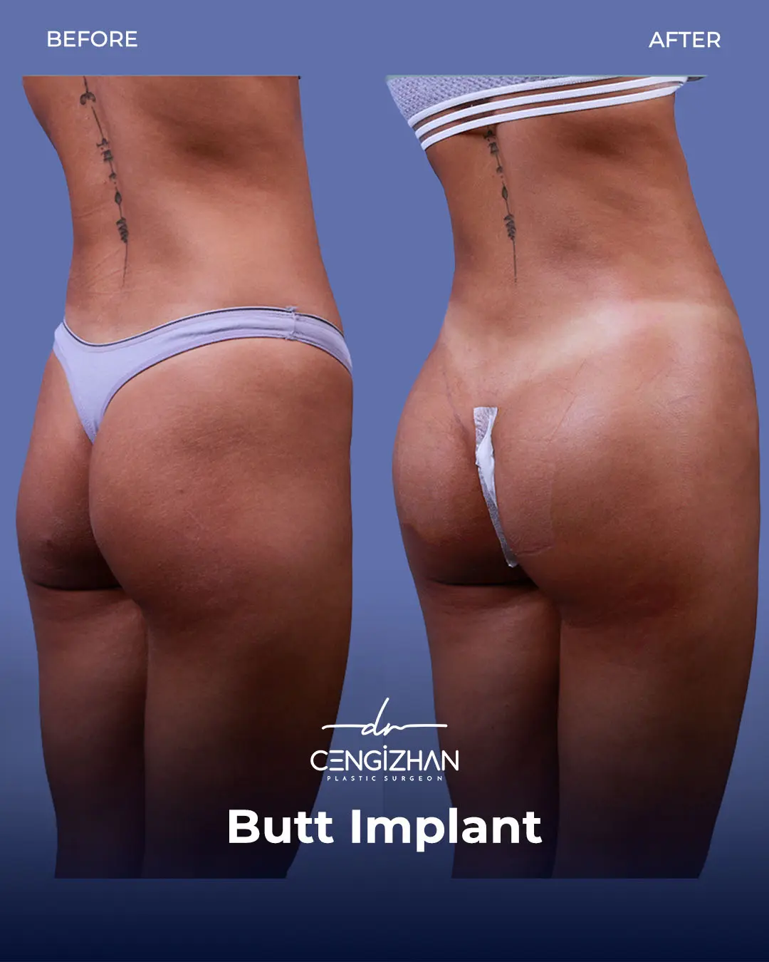 Butt Implants - Before and After - Real Transformation by Dr. Cengizhan Ekizceli