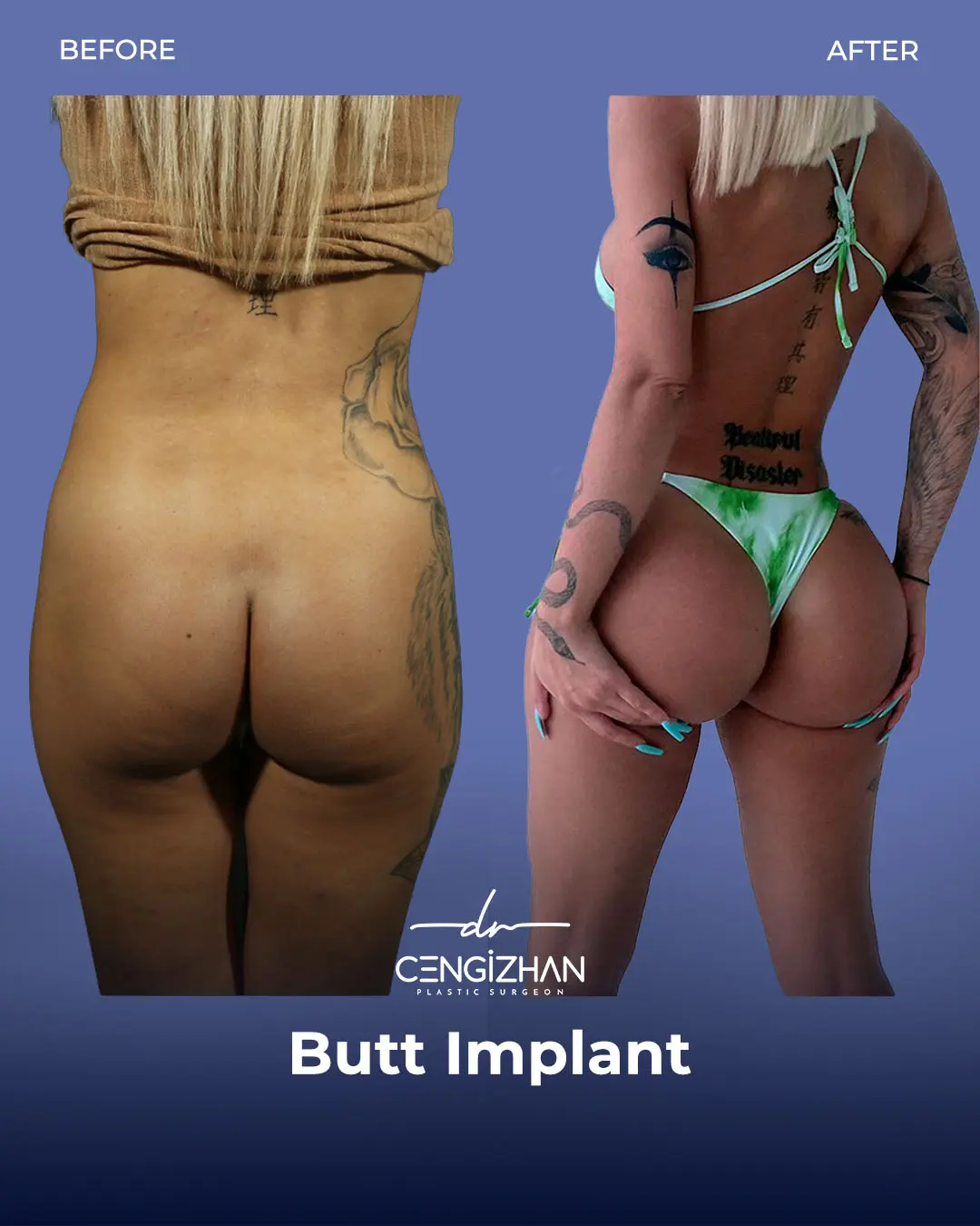 Butt Implants - Before and After - Real Transformation by Dr. Cengizhan Ekizceli