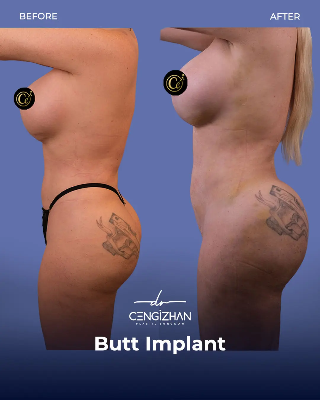Butt Implants - Before and After - Real Transformation by Dr. Cengizhan Ekizceli