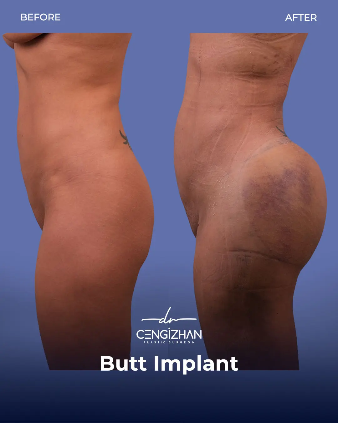 Butt Implants - Before and After - Real Transformation by Dr. Cengizhan Ekizceli