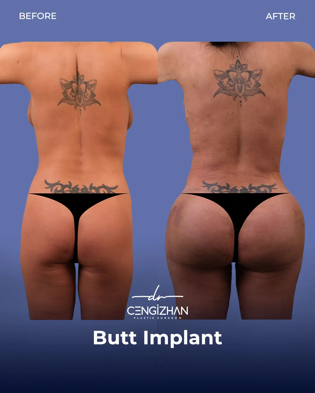Butt Implants - Before and After - Real Transformation by Dr. Cengizhan Ekizceli