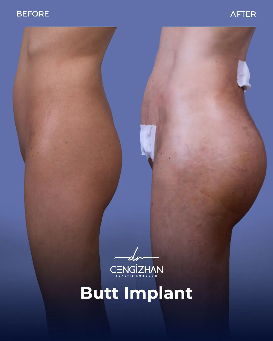 Butt Implants - Before and After - Real Transformation by Dr. Cengizhan Ekizceli