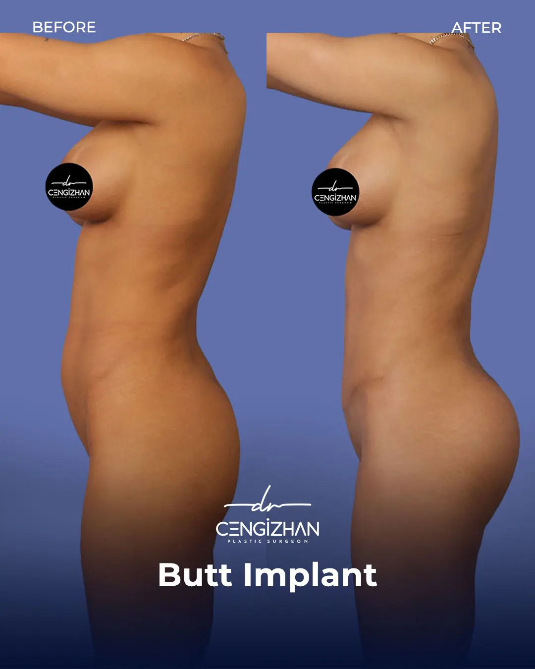 Butt Implants - Before and After - Real Transformation by Dr. Cengizhan Ekizceli