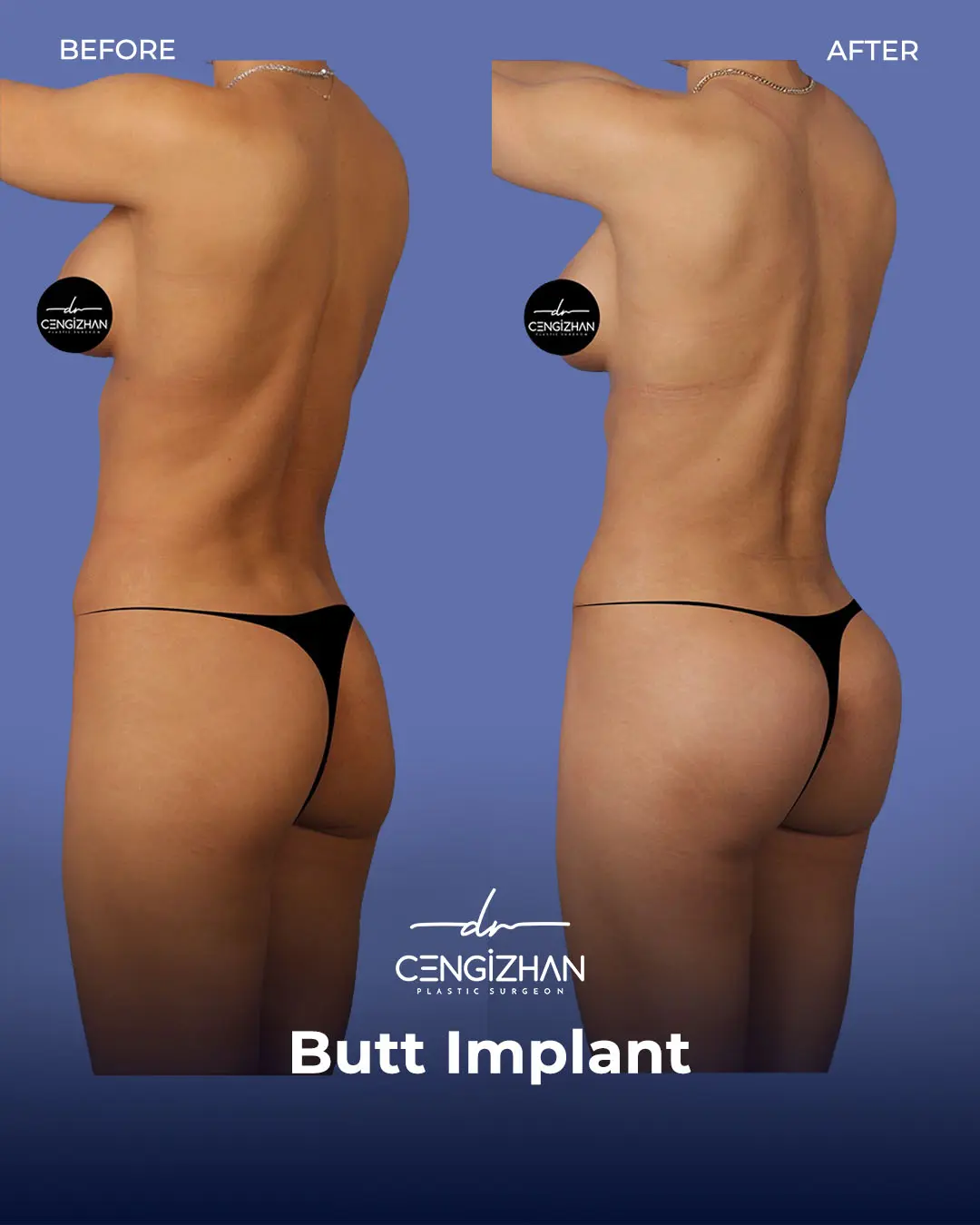 Butt Implants - Before and After - Real Transformation by Dr. Cengizhan Ekizceli