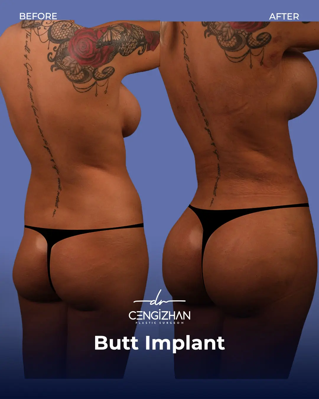 Butt Implants - Before and After - Real Transformation by Dr. Cengizhan Ekizceli