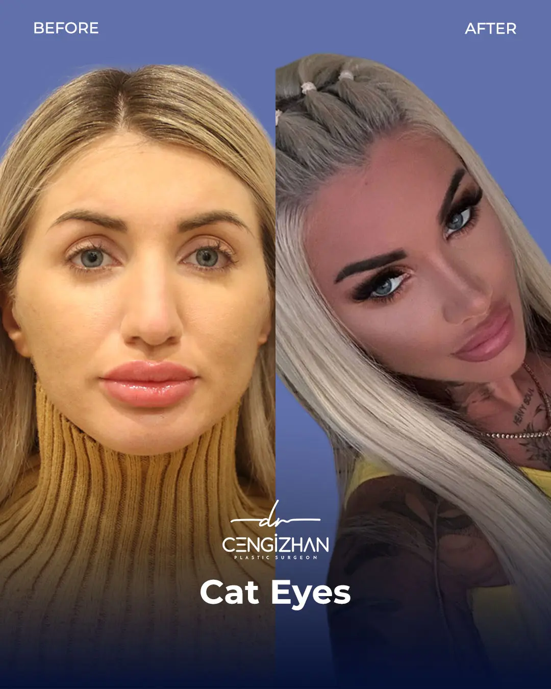 Cat Eye Surgery Before and After Results by Dr. Cengizhan Ekizceli