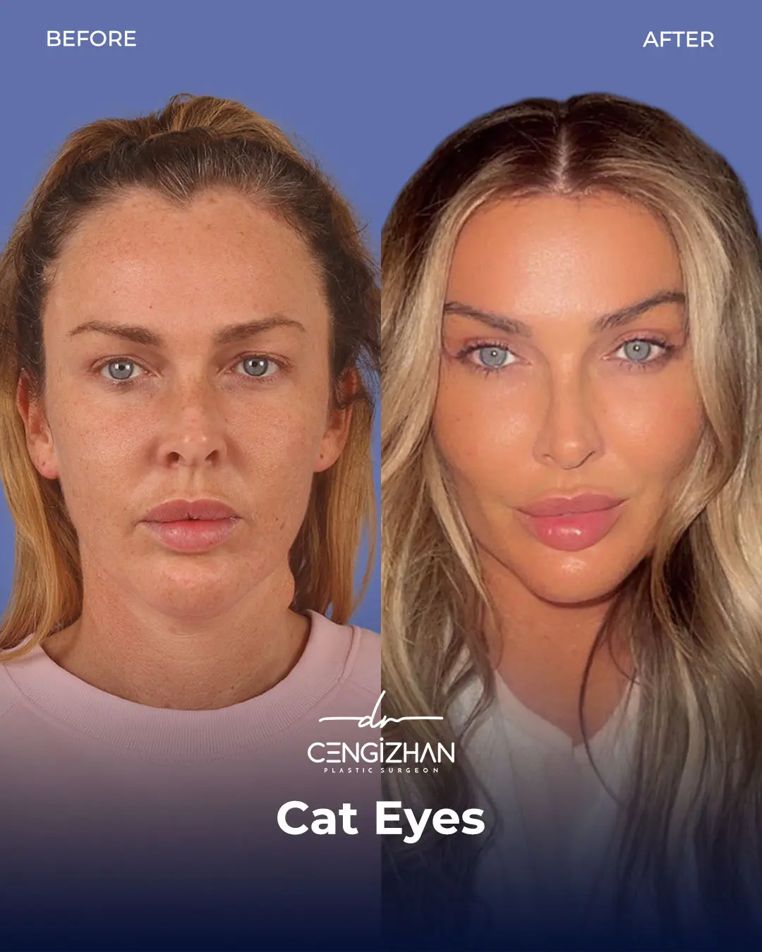 Cat Eye Surgery Before and After Results by Dr. Cengizhan Ekizceli