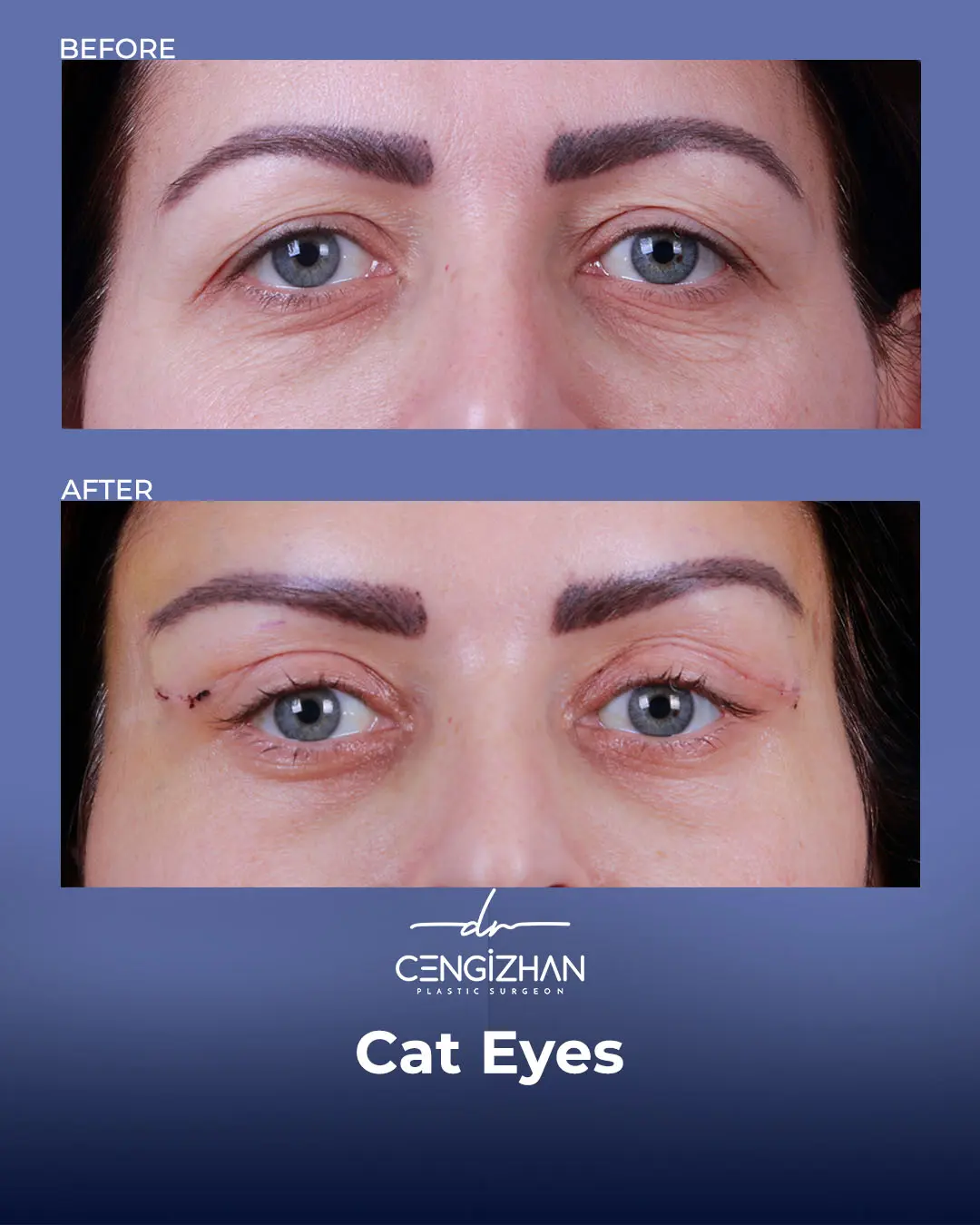 Cat Eye Surgery Before and After Results by Dr. Cengizhan Ekizceli