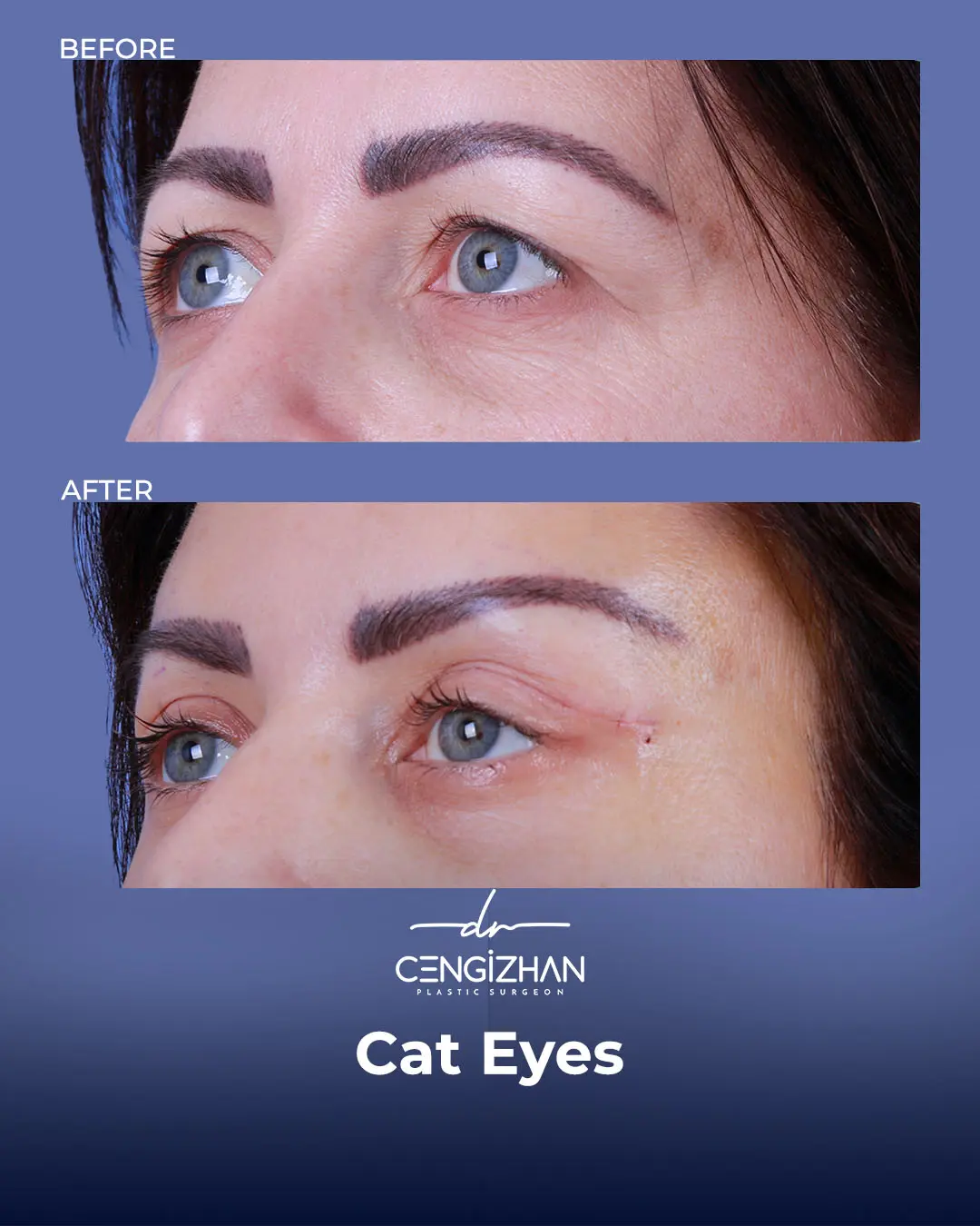Cat Eye Surgery Before and After Results by Dr. Cengizhan Ekizceli
