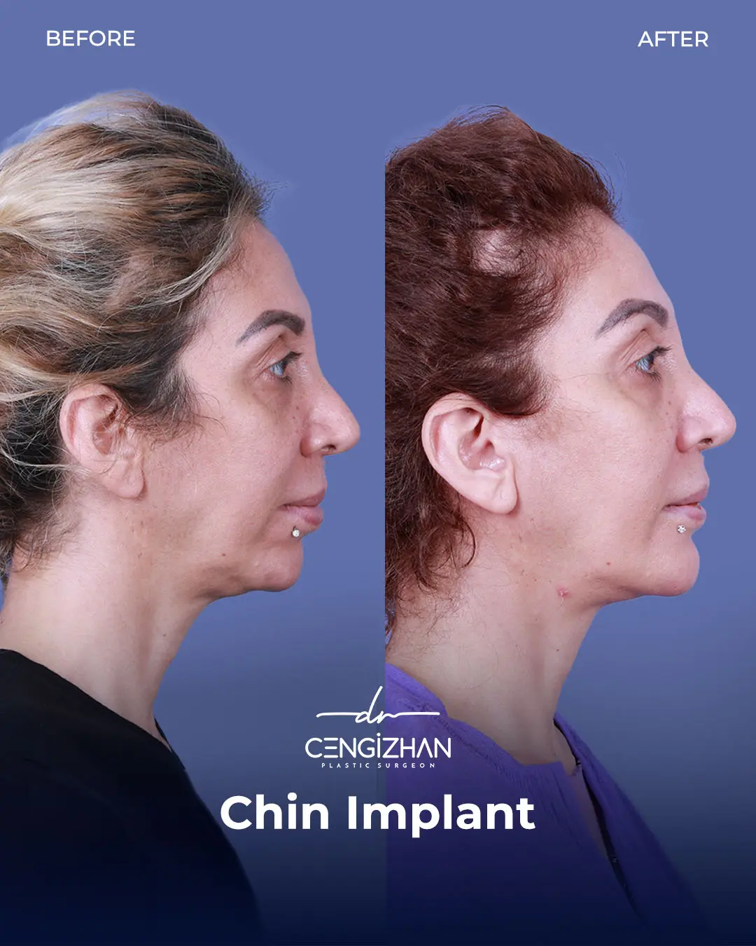 Chin Implant Real Patient Results by Dr. Cengizhan Ekizceli