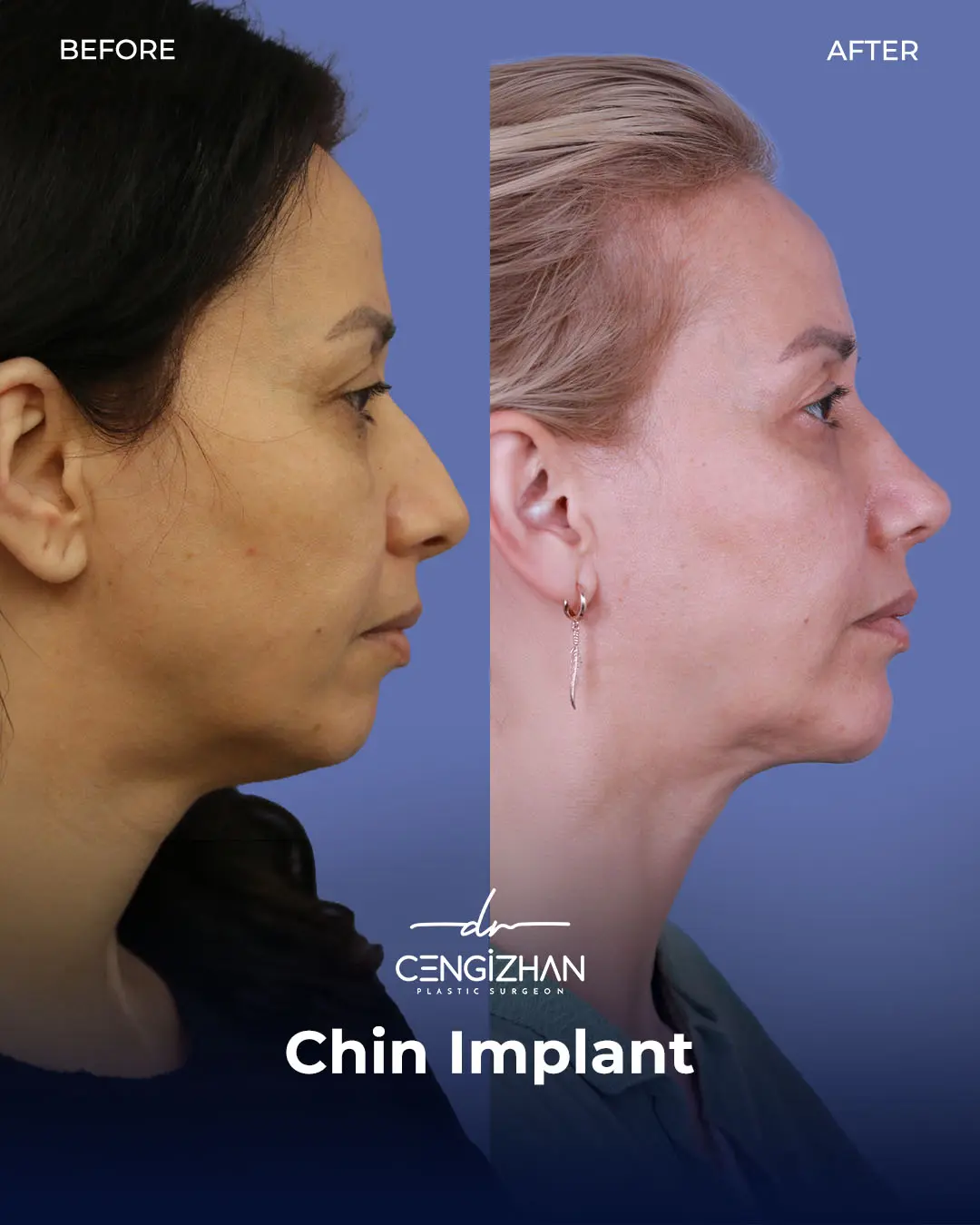 Chin Implant Real Patient Results by Dr. Cengizhan Ekizceli