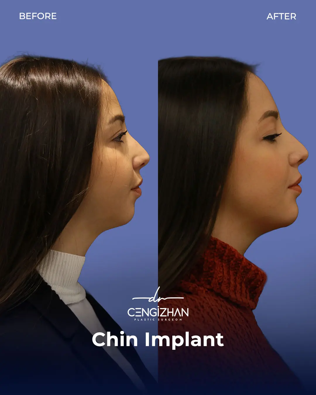 Chin Implant Real Patient Results by Dr. Cengizhan Ekizceli