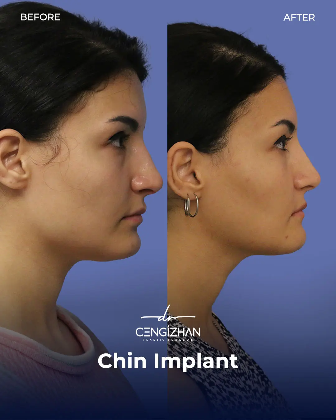 Chin Implant Real Patient Results by Dr. Cengizhan Ekizceli