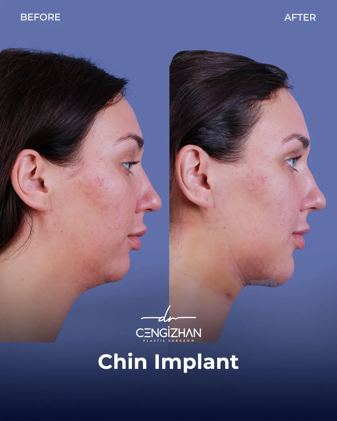 Chin Implant Real Patient Results by Dr. Cengizhan Ekizceli