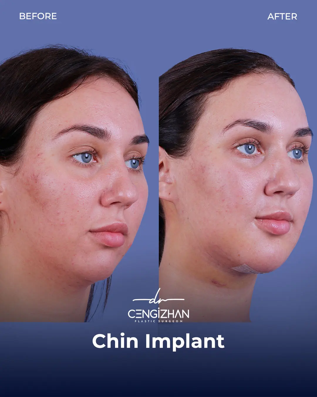Chin Implant Real Patient Results by Dr. Cengizhan Ekizceli