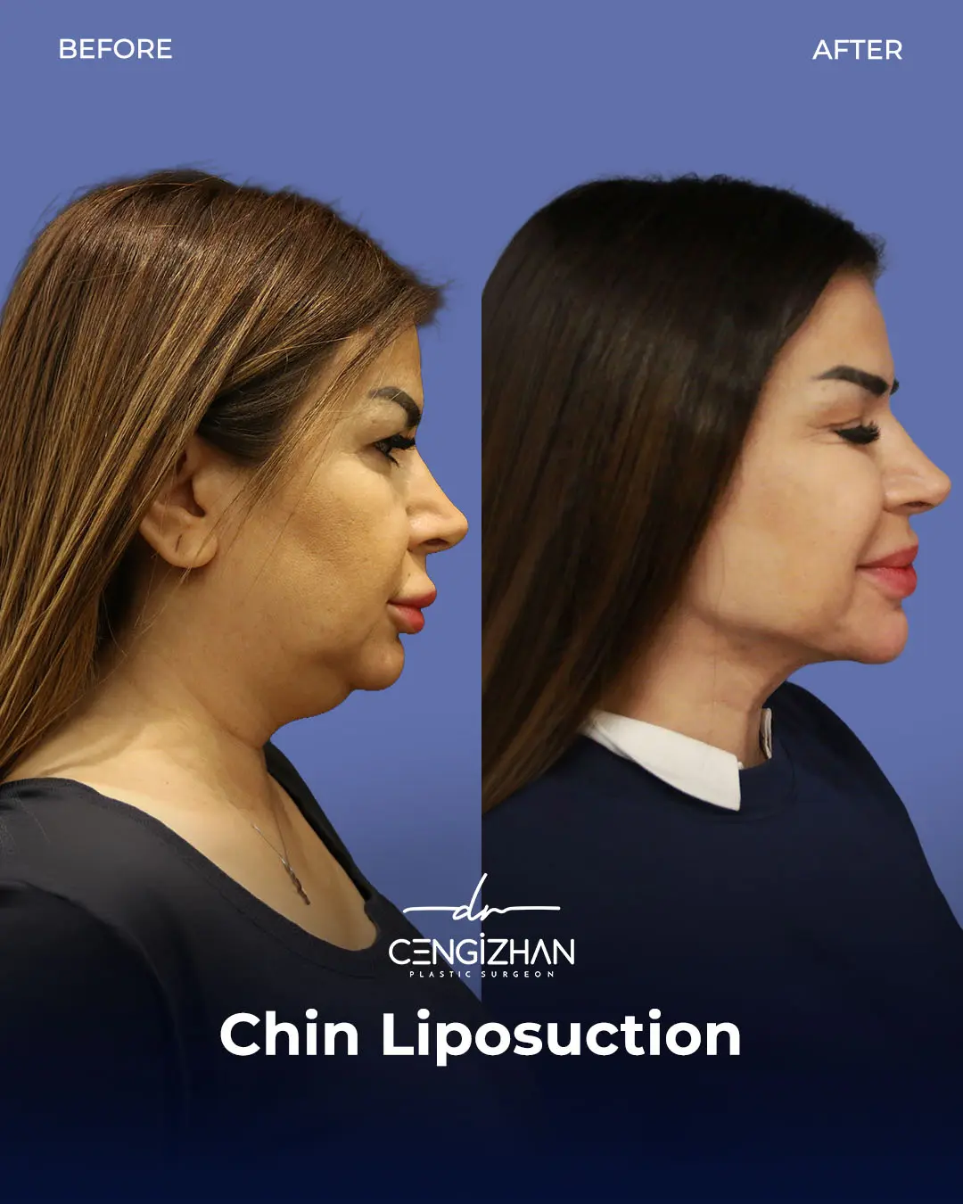Chin Liposuction Real Patient Results by Dr. Cengizhan Ekizceli