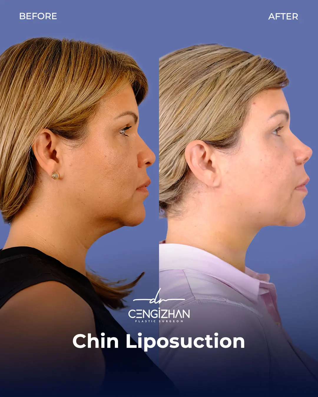 Chin Liposuction Real Patient Results by Dr. Cengizhan Ekizceli