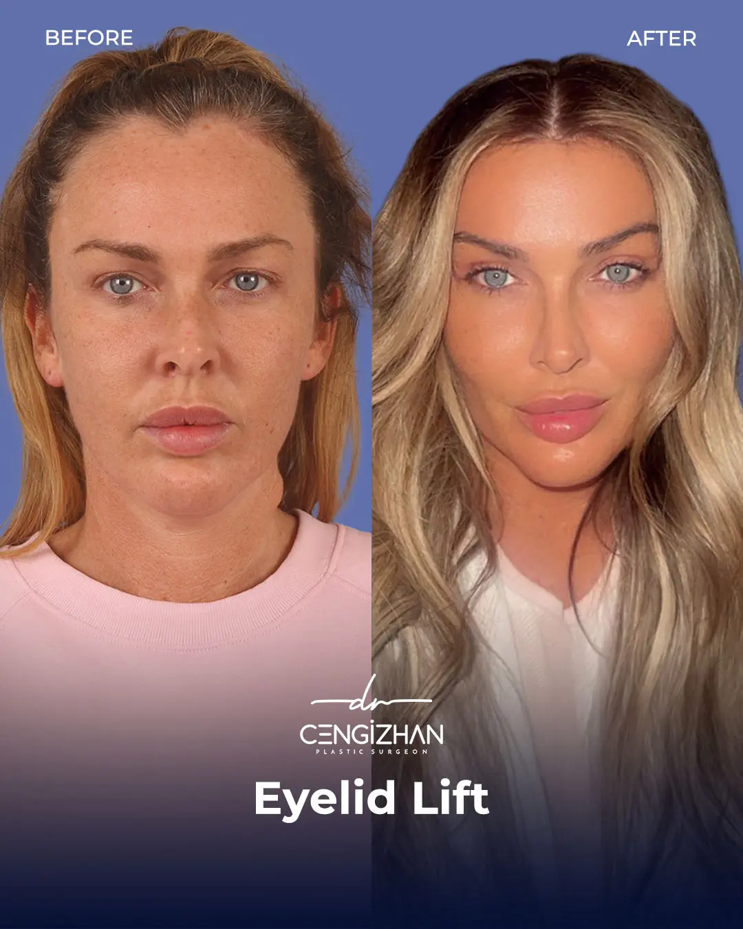 Eyelid Lift Surgery Results (Real Patient  Photo) by Dr. Cengizhan Ekizceli