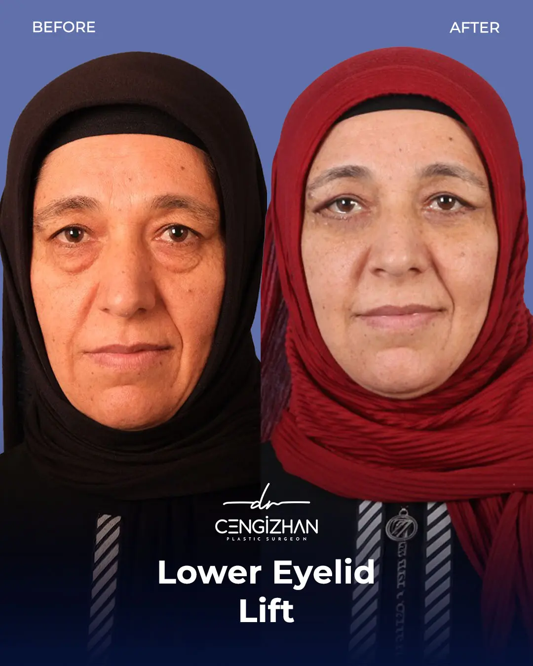 Eyelid Lift Surgery Results (Real Patient  Photo) by Dr. Cengizhan Ekizceli