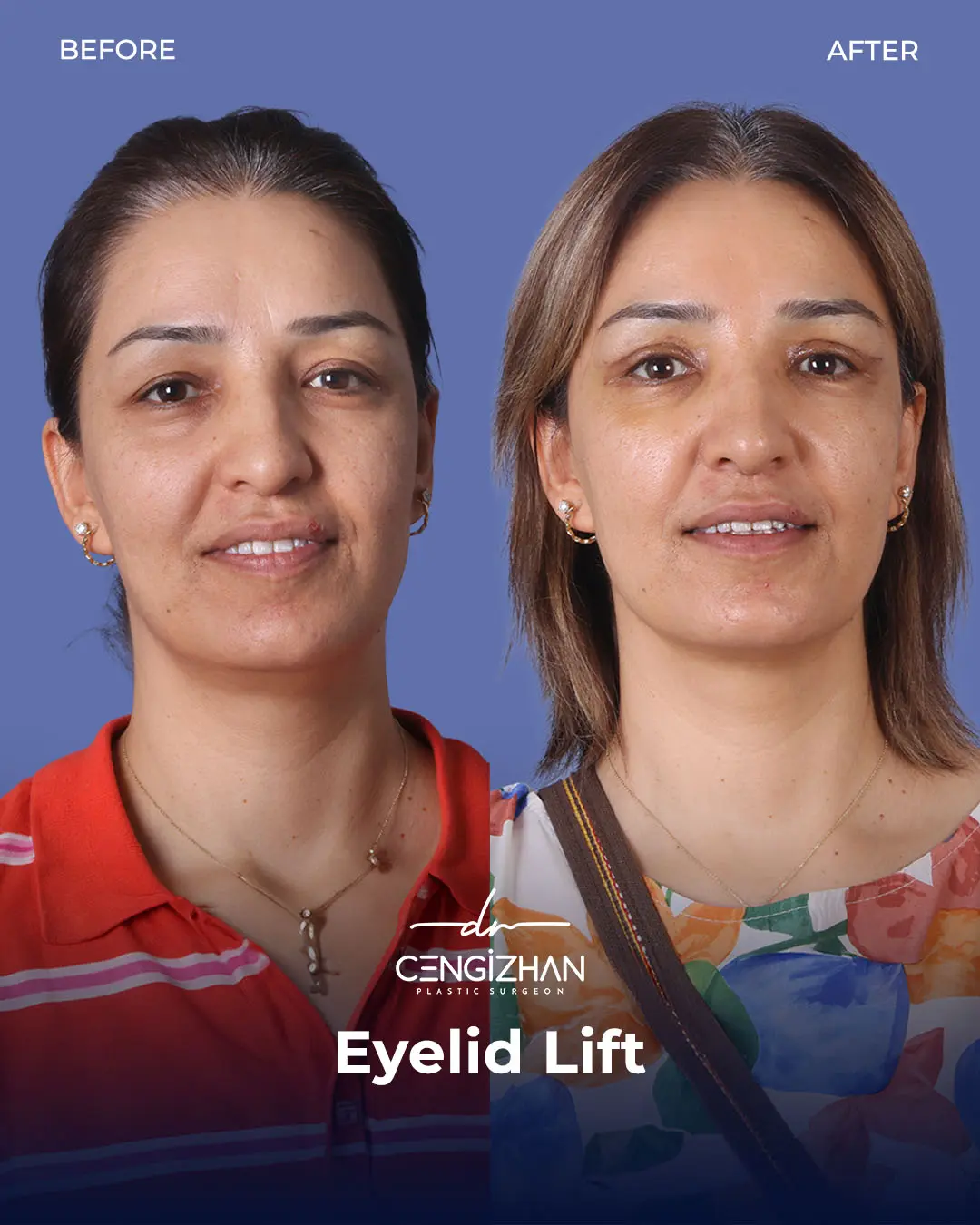 Eyelid Lift Surgery Results (Real Patient  Photo) by Dr. Cengizhan Ekizceli