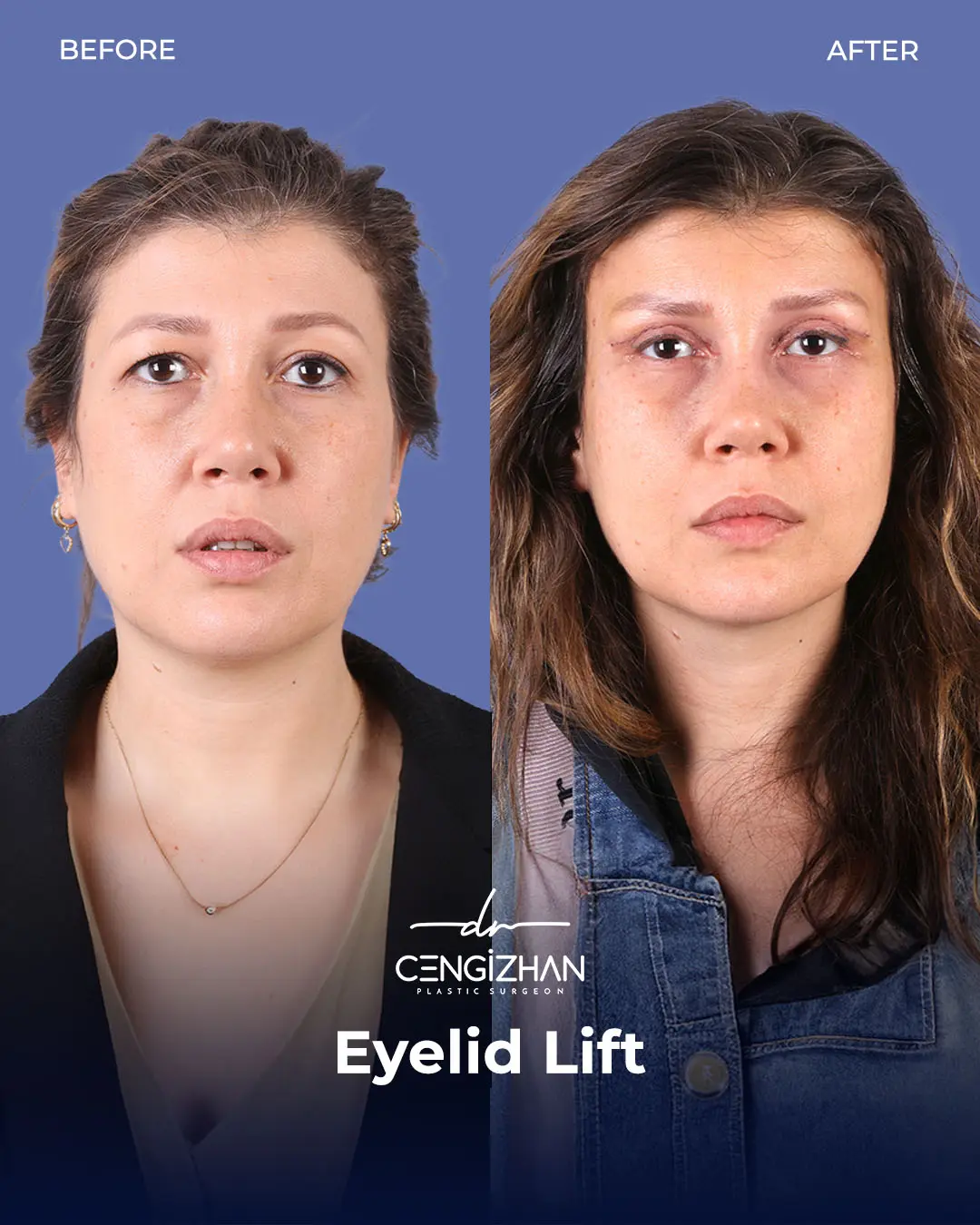 Eyelid Lift Surgery Results (Real Patient  Photo) by Dr. Cengizhan Ekizceli