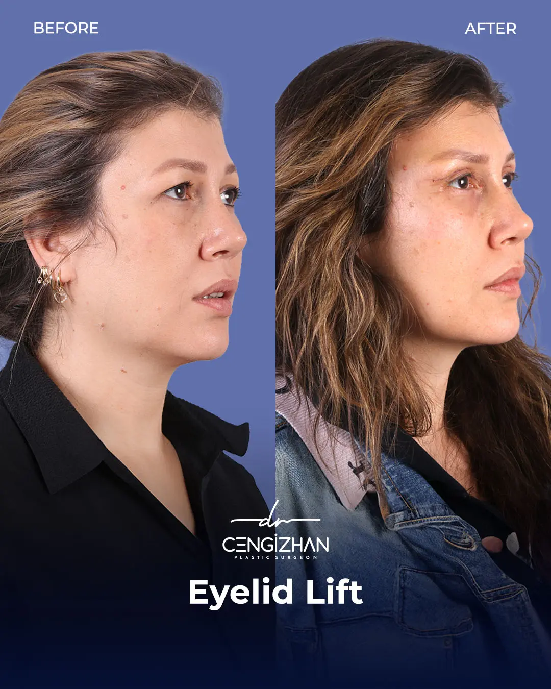 Eyelid Lift Surgery Results (Real Patient  Photo) by Dr. Cengizhan Ekizceli