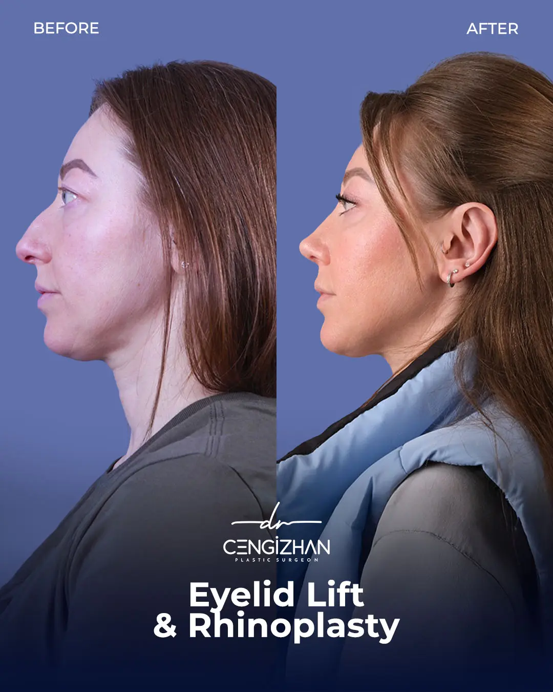 Eyelid Lift Surgery Results (Real Patient  Photo) by Dr. Cengizhan Ekizceli