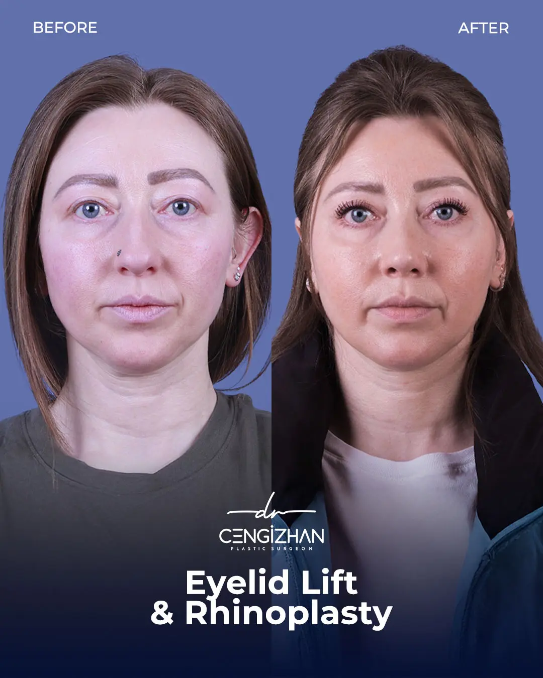 Eyelid Lift Surgery Results (Real Patient  Photo) by Dr. Cengizhan Ekizceli