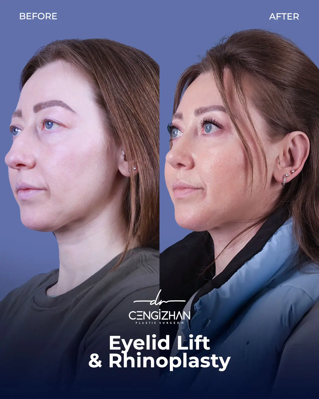 Eyelid Lift Surgery Results (Real Patient  Photo) by Dr. Cengizhan Ekizceli
