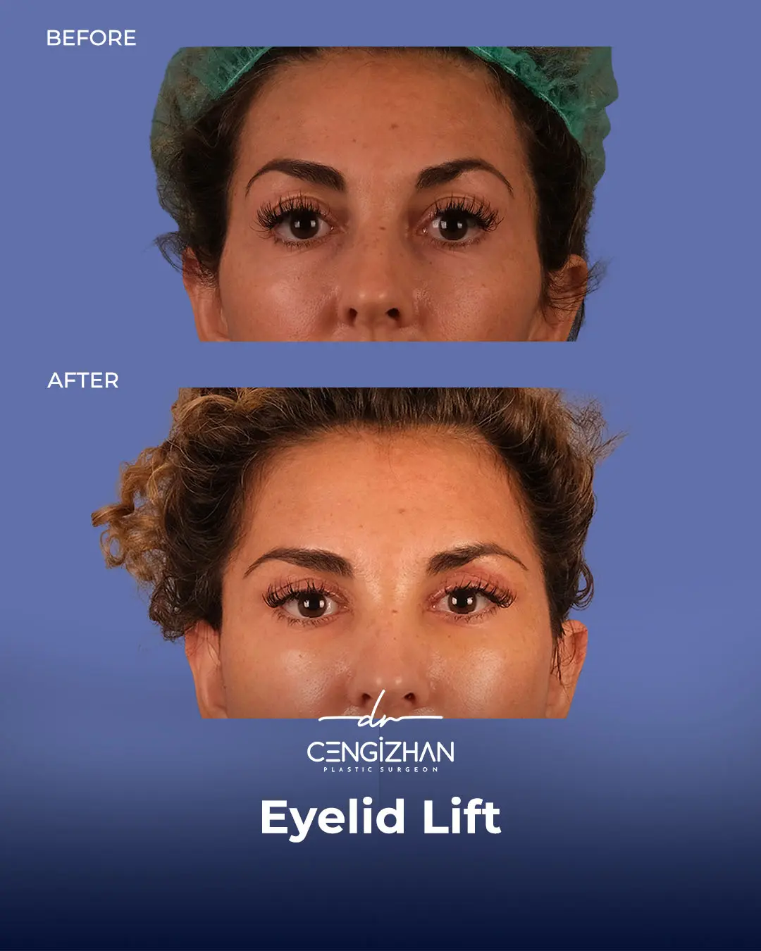 Eyelid Lift Surgery Results (Real Patient  Photo) by Dr. Cengizhan Ekizceli