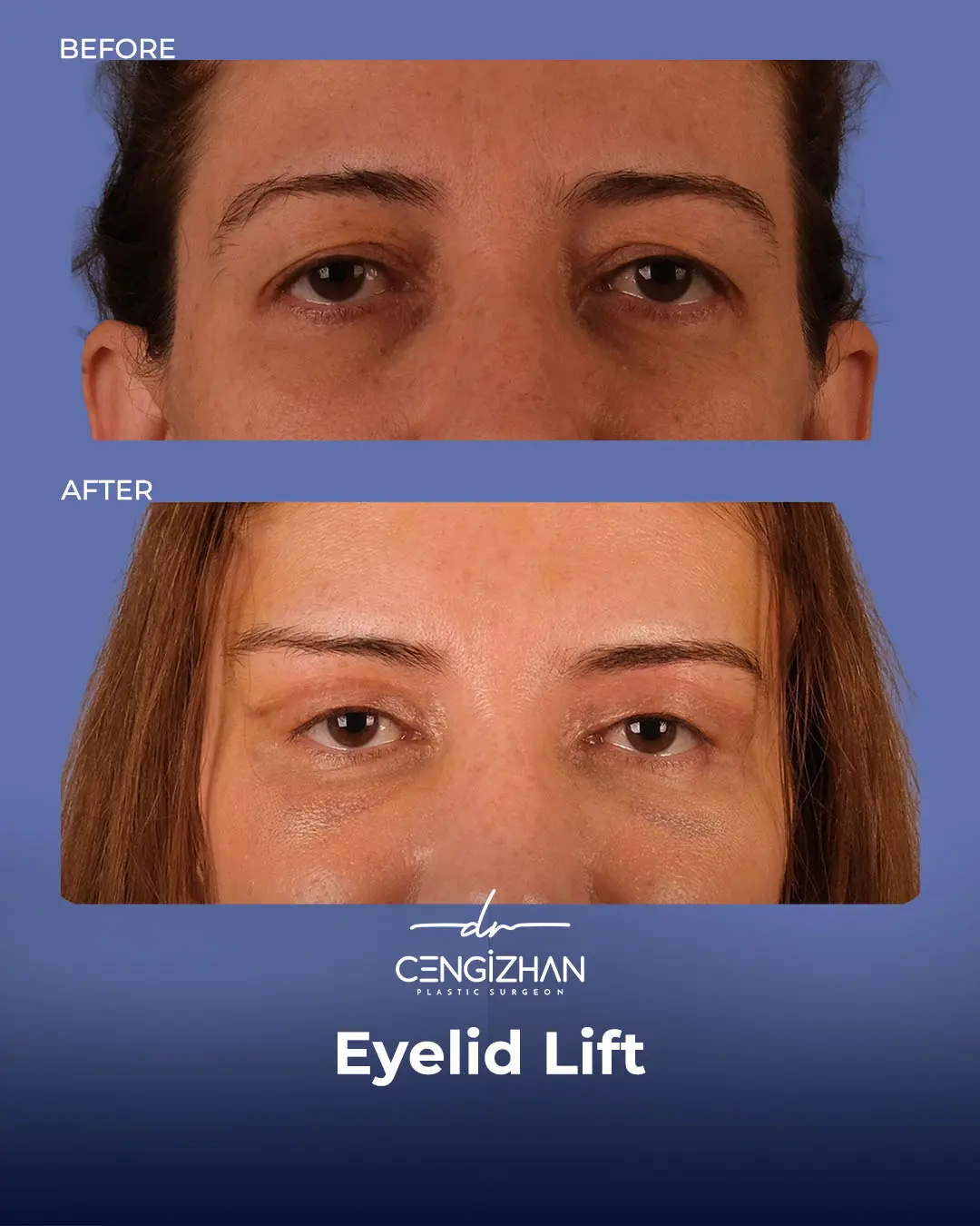 Eyelid Lift Surgery Results (Real Patient  Photo) by Dr. Cengizhan Ekizceli