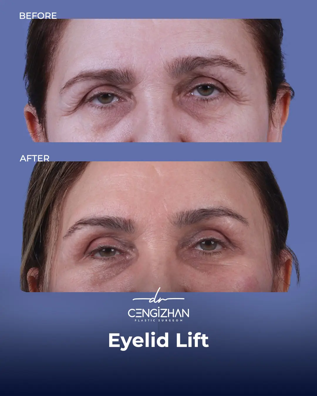 Eyelid Lift Surgery Results (Real Patient  Photo) by Dr. Cengizhan Ekizceli