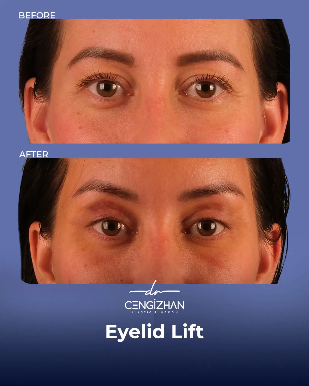 Eyelid Lift Surgery Results (Real Patient  Photo) by Dr. Cengizhan Ekizceli