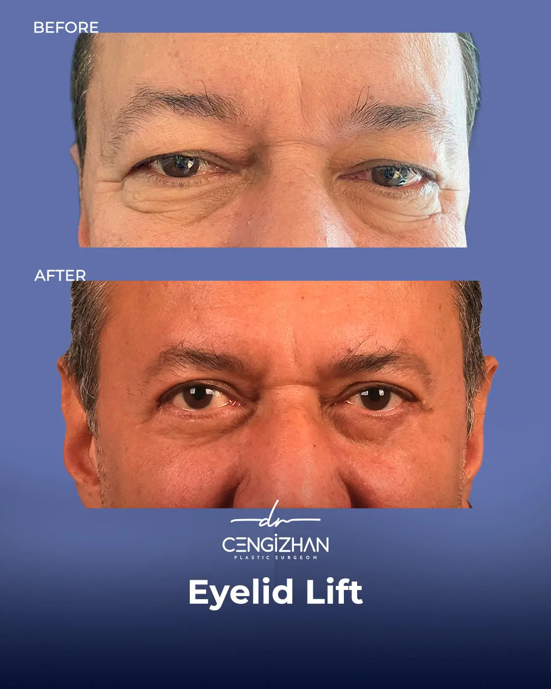 Eyelid Lift Surgery Results (Real Patient  Photo) by Dr. Cengizhan Ekizceli