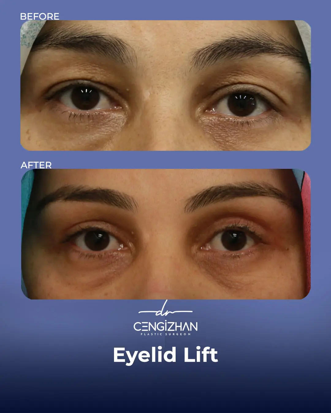 Eyelid Lift Surgery Results (Real Patient  Photo) by Dr. Cengizhan Ekizceli
