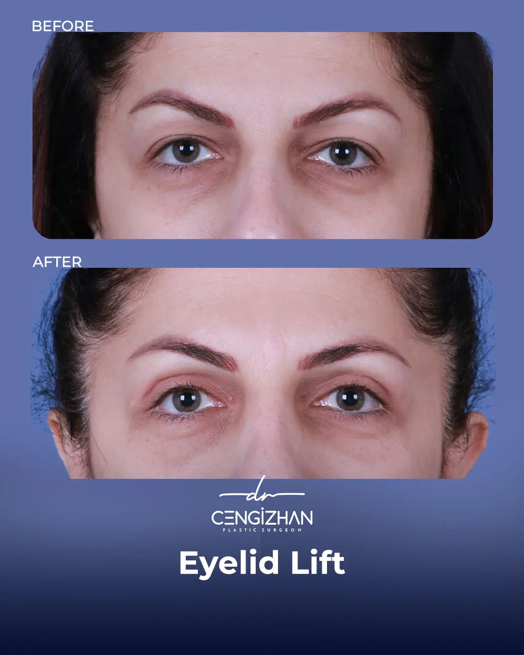 Eyelid Lift Surgery Results (Real Patient  Photo) by Dr. Cengizhan Ekizceli
