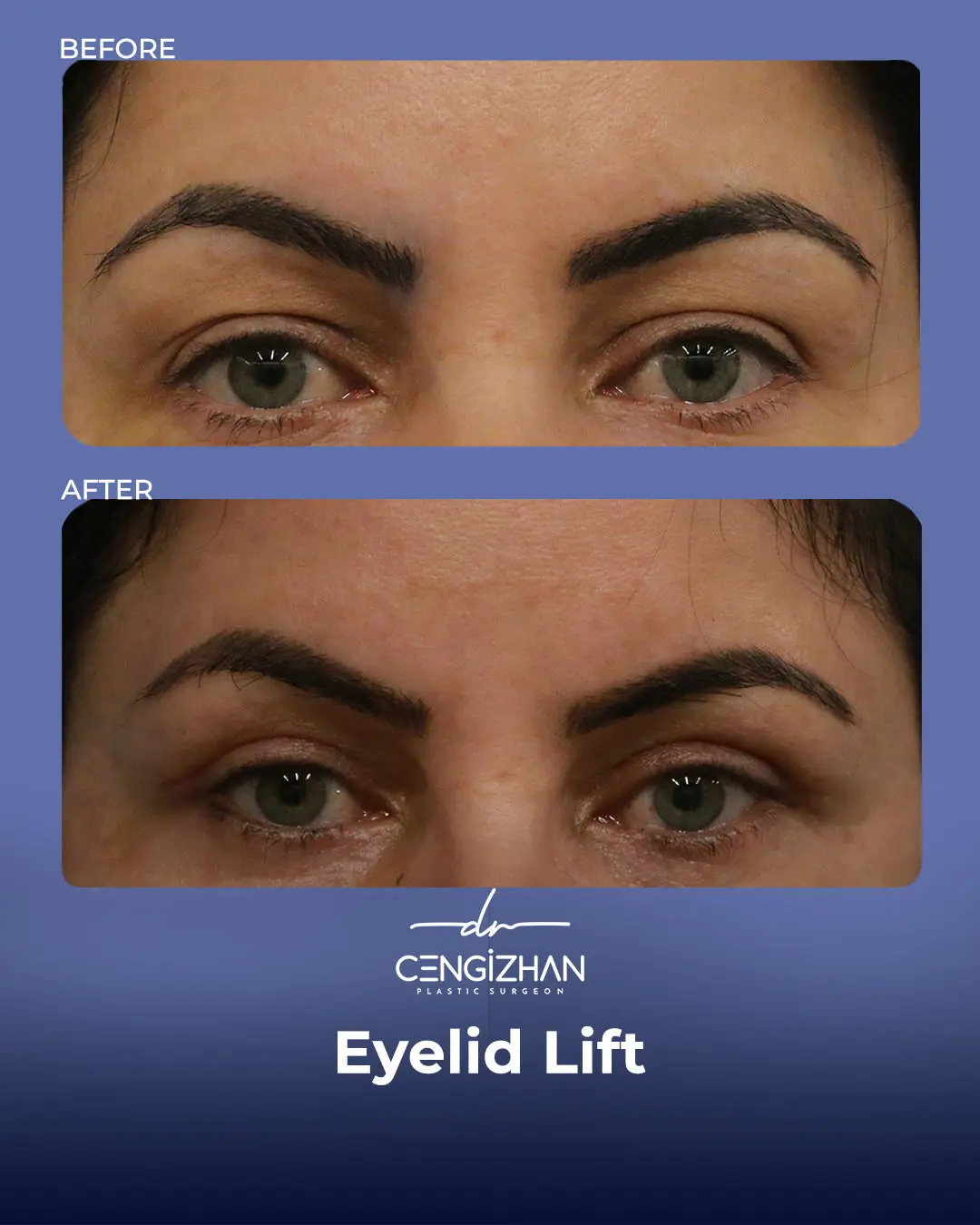 Eyelid Lift Surgery Results (Real Patient  Photo) by Dr. Cengizhan Ekizceli